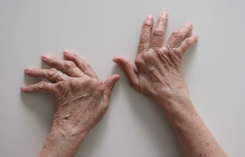 Руки Галины, обезображенные болезнью
