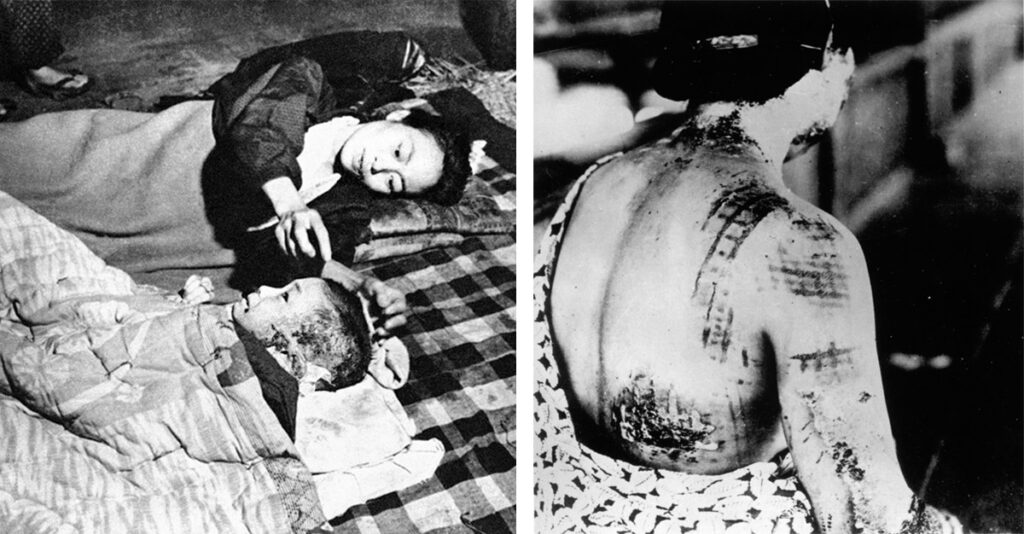 Слева – женщина и ее ребенок в здании банка, превращенном в госпиталь. 6 октября 1945 года. Фото AP Photo/ ТАСС Справа – жертва атомной бомбардировки. Термические лучи выжгли узор от кимоно на ее спине. Фото AP Photо/ ТАСС